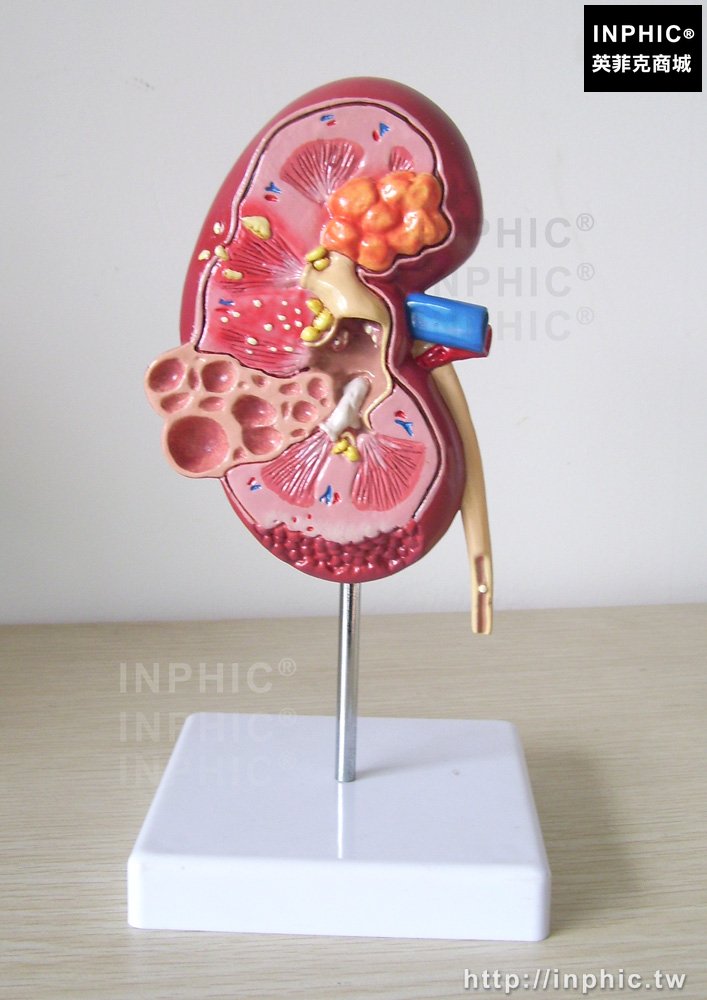 INPHIC-醫療實驗道具人體內臟器官解剖模型醫學模型人體腎解剖模型病變腎臟模型