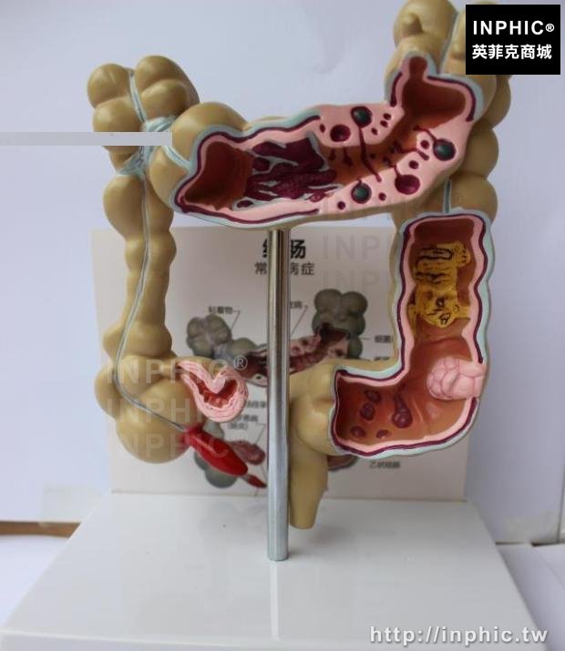 INPHIC-人體結腸病變模型醫學模型大腸模型醫療實驗道具大腸病理模型腸道疾病大腸病變模型
