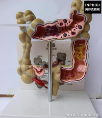 INPHIC-人體結腸病變模型醫學模型大腸模型醫療實驗道具大腸病理模型腸道疾病大腸病變模型