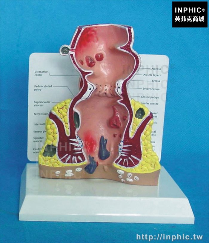 INPHIC-腸直腸解剖病理模型醫療實驗道具醫學模型痔瘡直腸病理模型潰楊性結腸病病態疾病教具