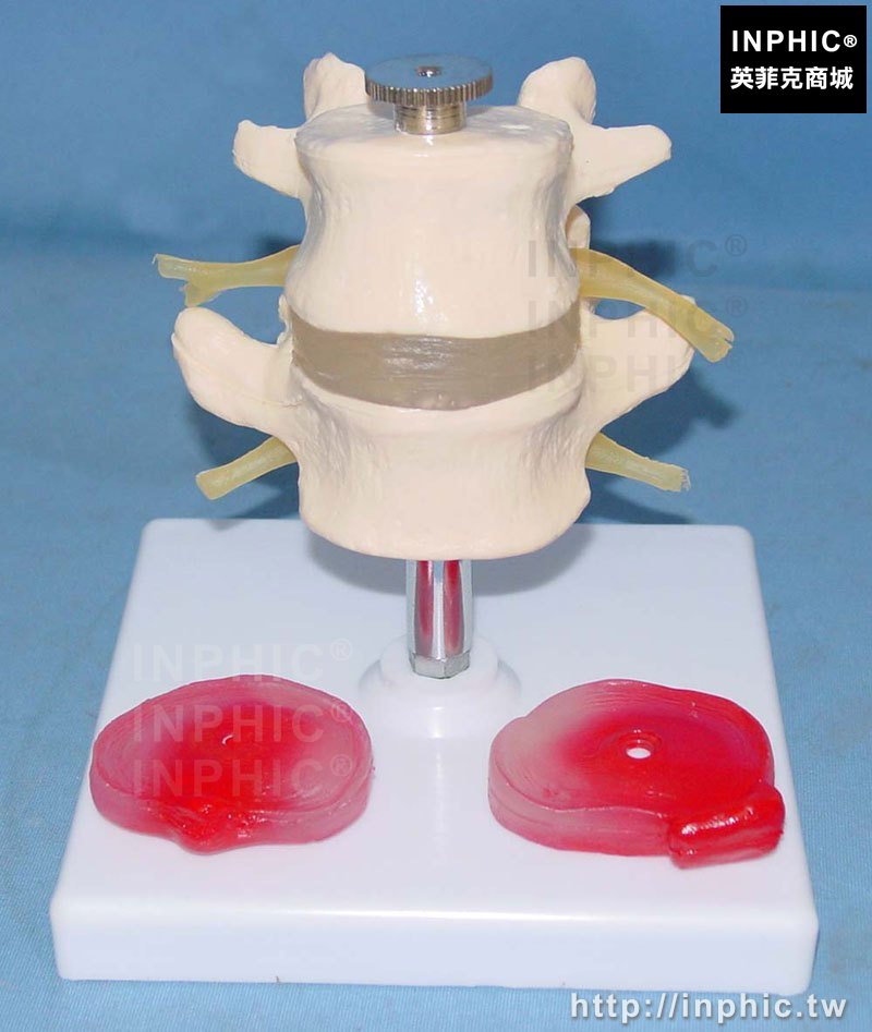 INPHIC-人體腰椎椎間盤脊椎椎間盤比較模型腰椎醫學模型病態腰椎3個病變醫療實驗道具